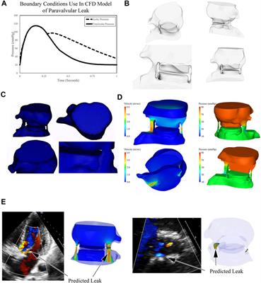 The native aortic valve reduces paravalvular leak in TAVR patients